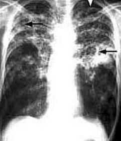 X-ray radiograph of a human's chest showing a ancerous area in the left lung