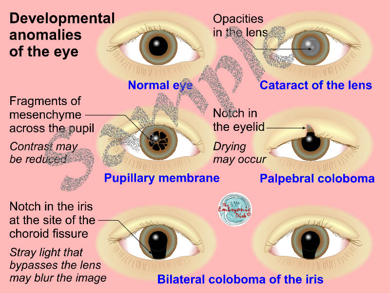 Developmental anomalies of the eye