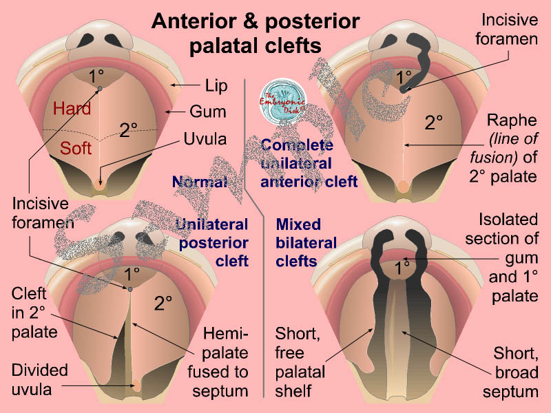 Anterior and posterior palatal clefts