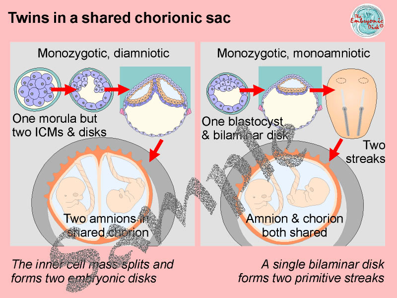 Twins in a shared chorionic sac