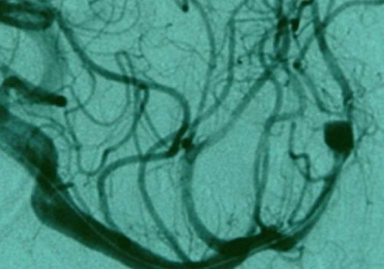 Aneurysm - image adapted from doi:10.1186/1752-1947-1-168 / CC BY