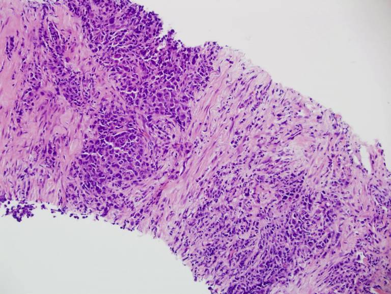 Microscope slide showing small cell variant of epidermoid carcinoma of the lung. Image by Yale Rosen and Jian-Hua Qiao, https://secure.flickr.com/people/pulmonary_pathology/. Licensed under the Creative Commons Attribution-Share Alike 2.0 Generic licence
