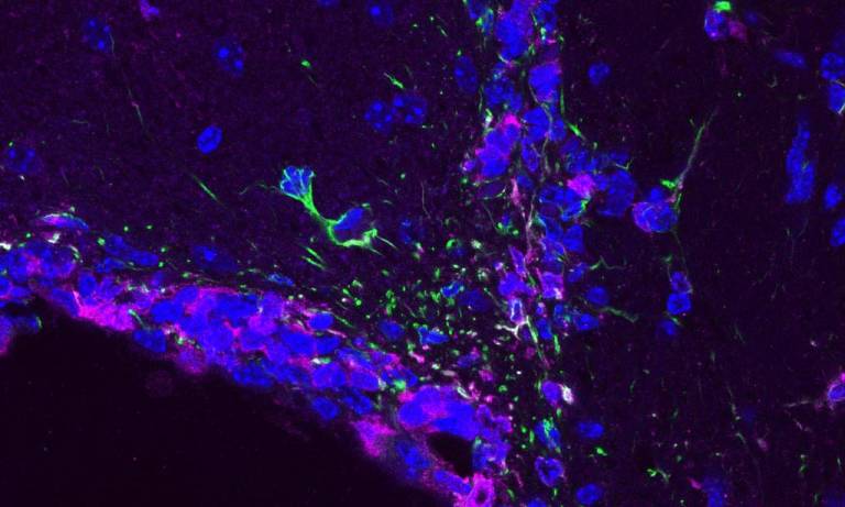 Cancer cells brain tumours