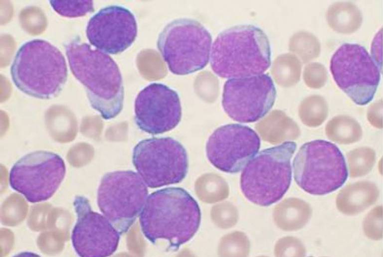 Microscopy image of leukaemia