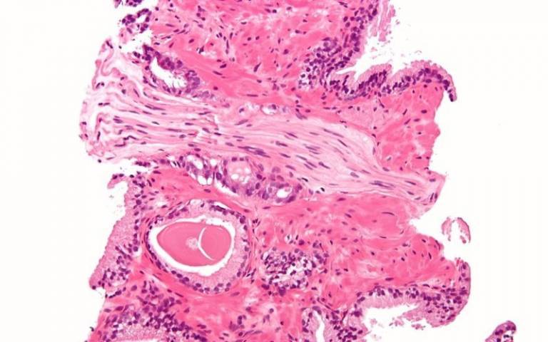 Prostatic adenocarcinoma with perineural invasion