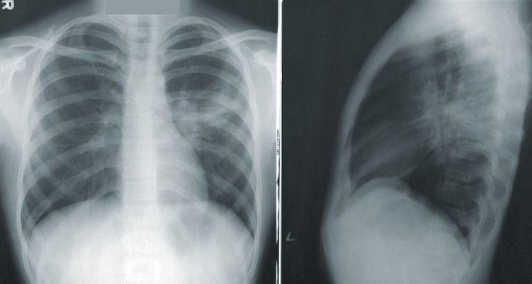 Lung x-ray pneumonia