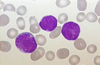 Acute Lymphoblastic Leukaemia peripheral blood
