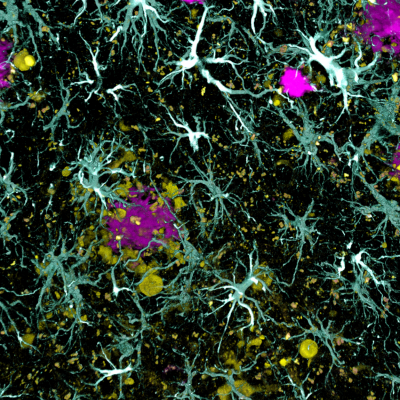 astrocytes surrounding amyloid plaques