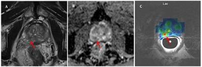 Three images show an axial T2 weighted MRI…