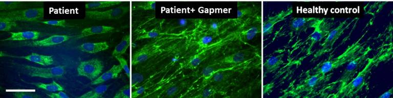 Gapmer antisense oligonucleotides decreased intracellular collagen VI retention and increased its extracellular matrix deposition in patient’s fibroblasts (Marrosu et al. 2017)