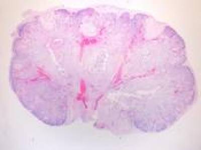 Histological section of a fetal kidney demonstrating cystic dysplasia