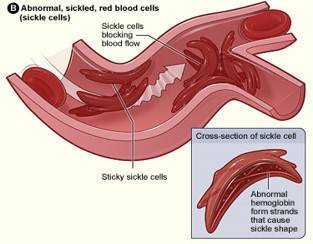 Sickle Cell Diagram