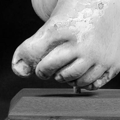 Plaster cast illustrating club foot