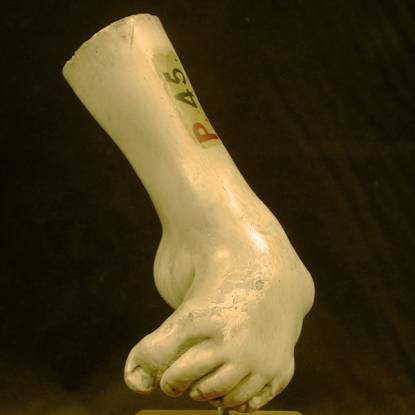 Plaster cast illustrating club foot