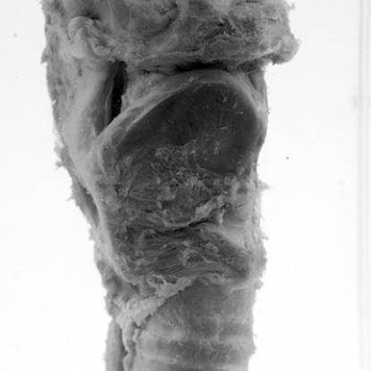 Specimen showing a choking larynx