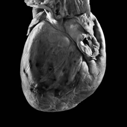 Specimen showing a sword swallower's heart and oesophagus