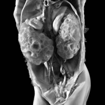 Specimen showing polycystic kidney disease