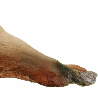 Specimen showing senile dry gangrene