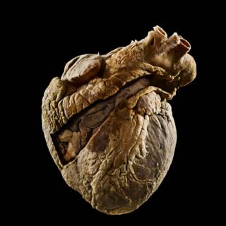 Heart specimen showing a pulmonary embolism photographed against a black background