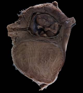 Uterine fibroid specimen with pregnancy, photographed against a black background