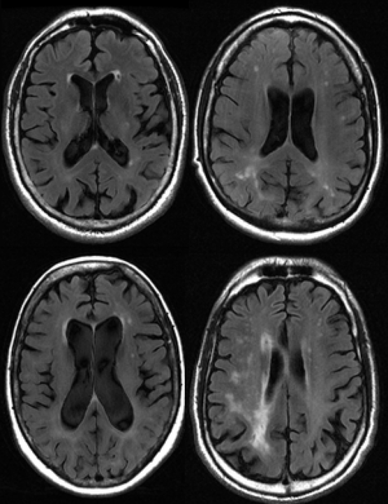 Examples of white matter disease…