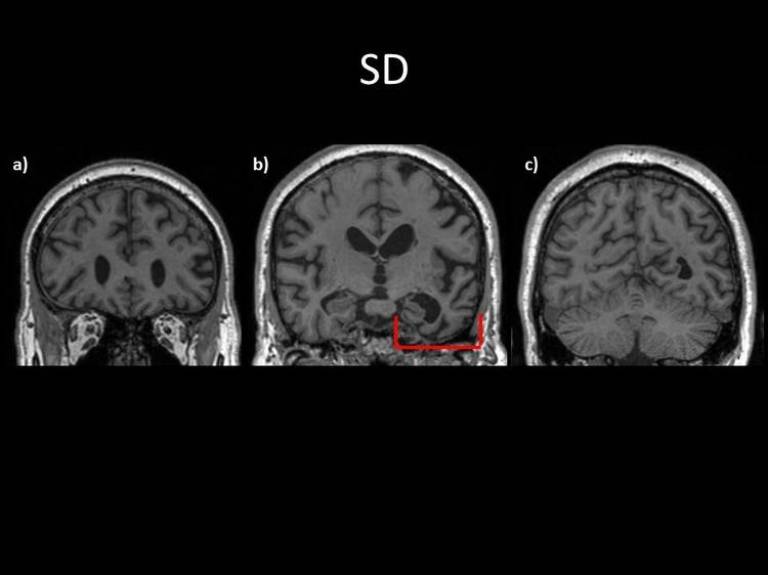 Semantic Dementia Brain Image…