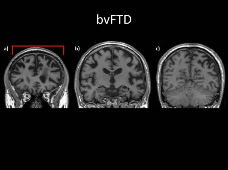 bvFTD Brain Image…