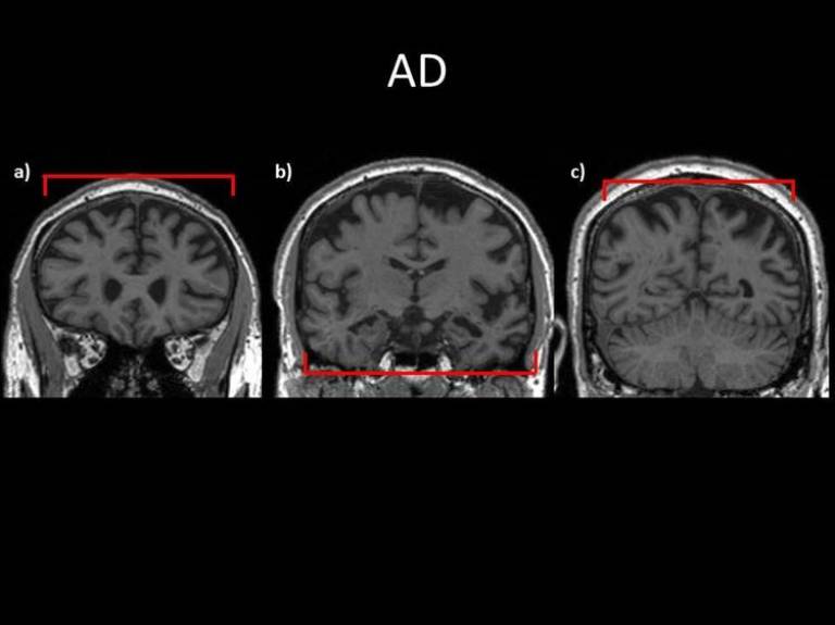 tAD Brain Image…