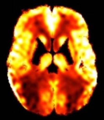 Arterial spin labelling (ASL) scan of a patient with posterior cortical atrophy…