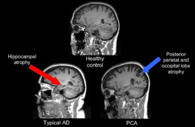 Brain scans of control, AD and PCA…