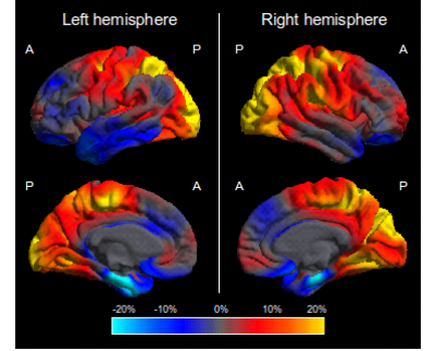 Figure 1. Regional percentage differences in cortical thickness in PCA (N=48) compared with typical amnestic AD (tAD; N=30) for the left and right hemisphere (Lehmann et al., 2009). The colour scale represents magnitude of cortical thickness differen…