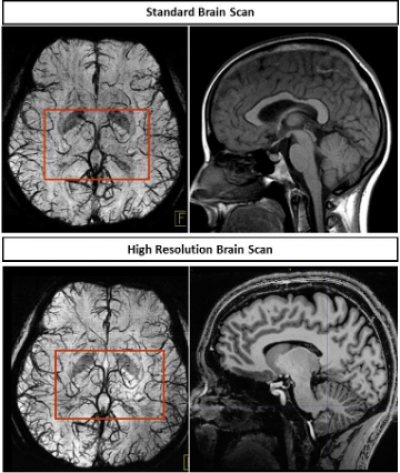 High res PCA MRI