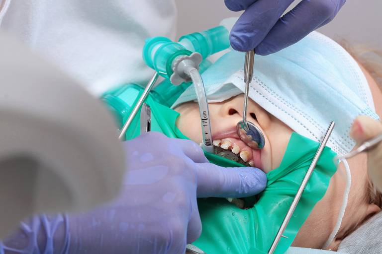 Treatment of caries on milk teeth under general anesthesia.