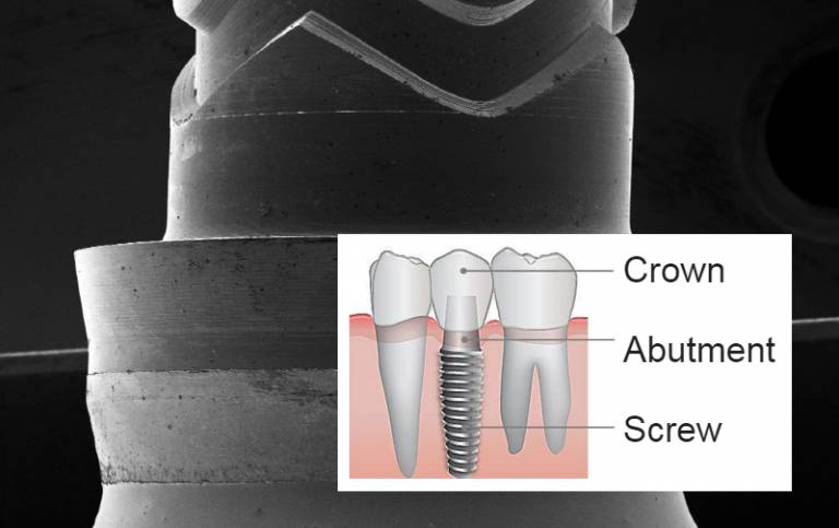 Dental implant structure and close up