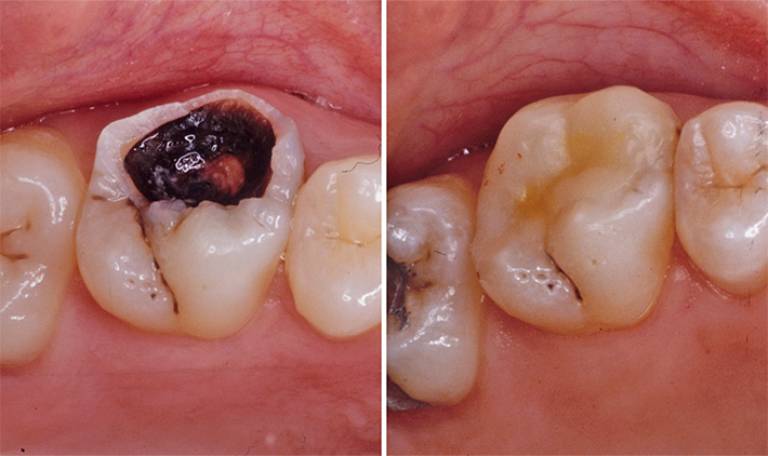 Image of tooth with decay and same tooth with composite filling applied