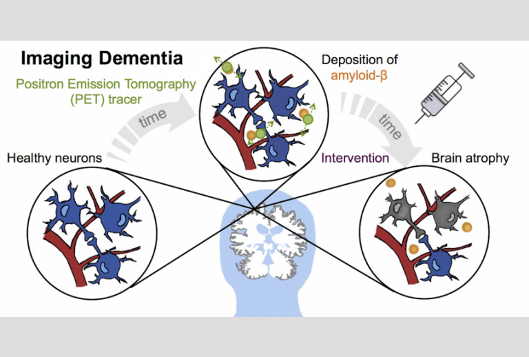 Imaging dementia