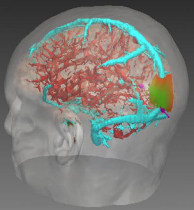Risk map of brain