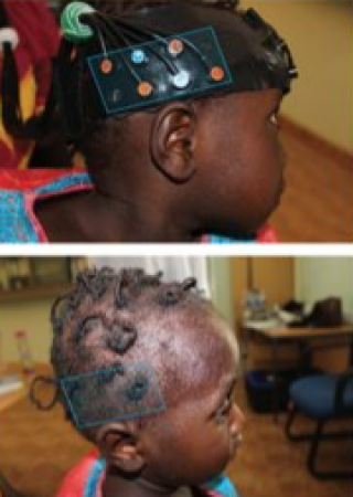image of a girl with braids wearing a medical device on her head