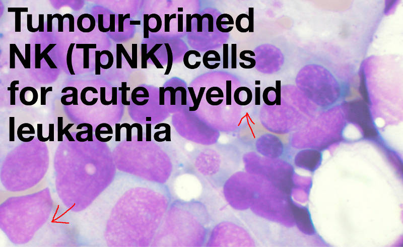 Tumour-primed NK (TpNK) cells for acute myeloid leukaemia