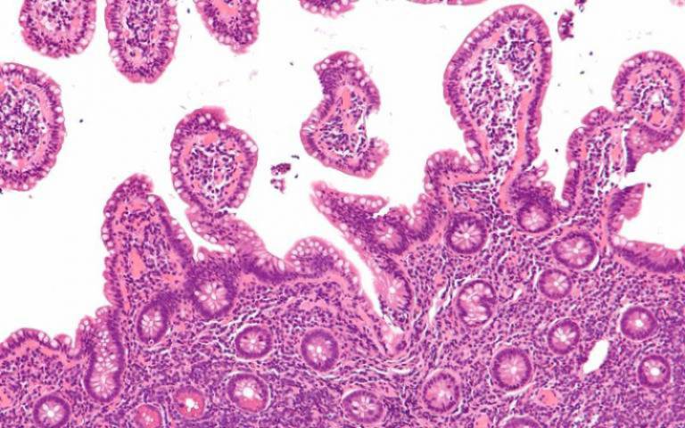 Micrograph of mantle cell lymphoma