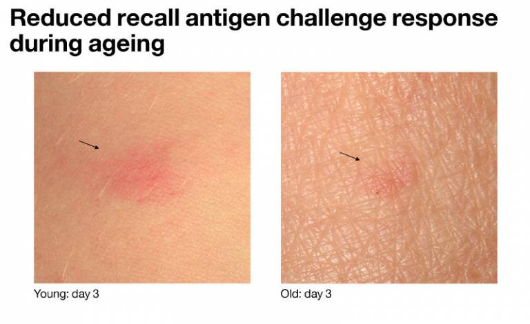 Reduced recall antigen challenge response during ageing