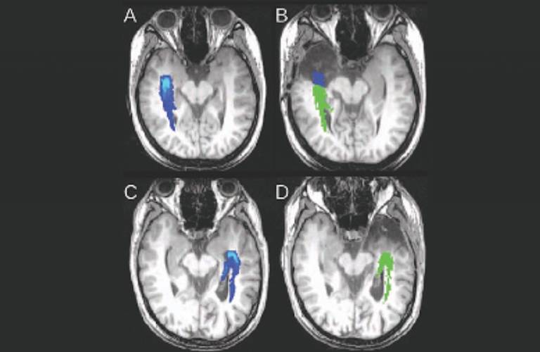 Pre-operative and post-operative images of two patients who underwent an anterior temporal lobe resection as treatment for severe epilepsy