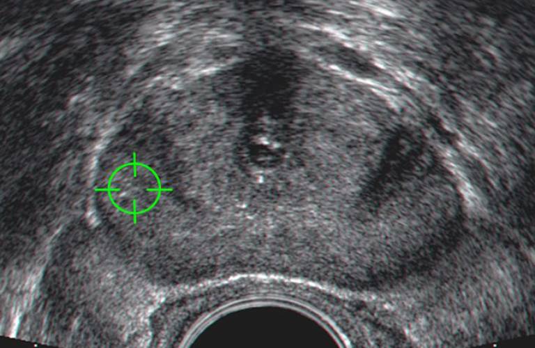 Prostate image with target. Courtesy Dean Barratt