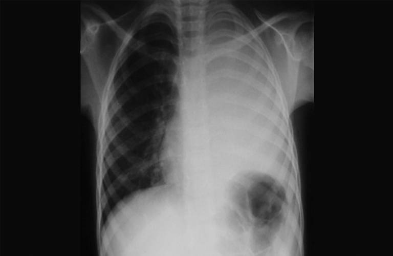 Chest x-ray showing left-sided empyema