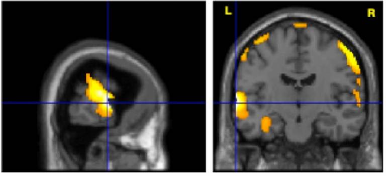 fMRI use in neurosurgical treatment for epilepsy