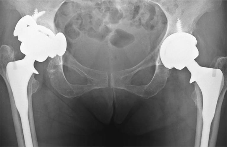 Hip replacement xray