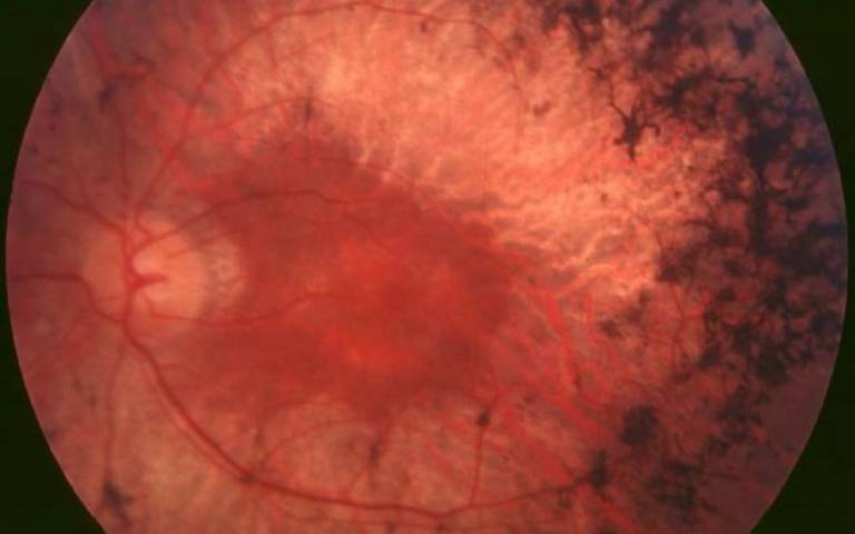 view of back of a human eye
