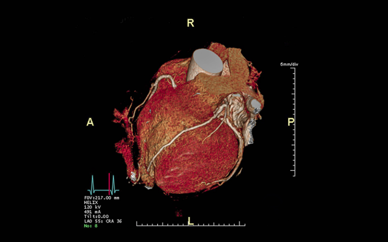 CTA Coronary artery 3D rendering image