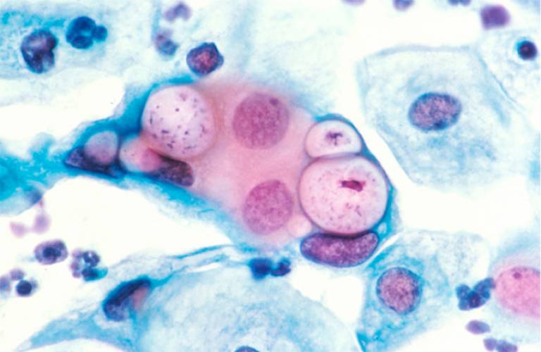 Chlamydia in a cervical smear