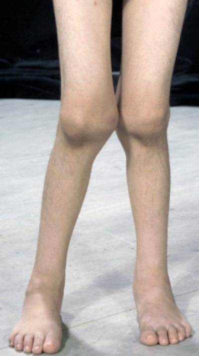 A child's legs affected by juvenile idiopathic arthritis. Courtesy Centre for Adolescent Rheumatology
